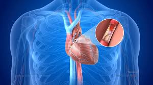 Heart Bypass